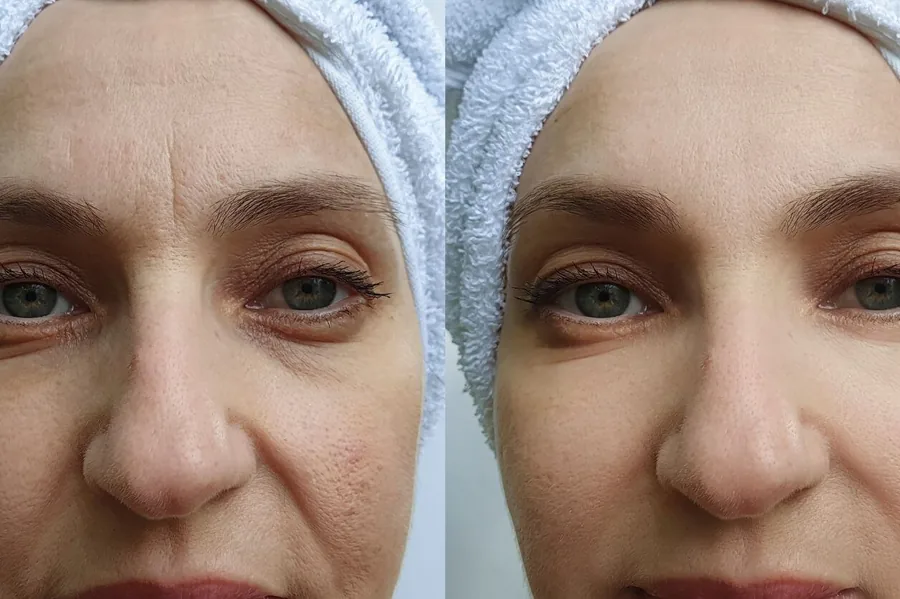 Botox vs. Dysport: Which Wrinkle Relaxer Is Right for You?
