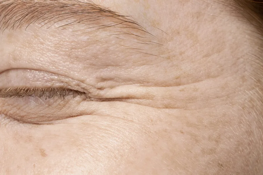 Dermal Fillers for Wrinkles: A Complete Guide