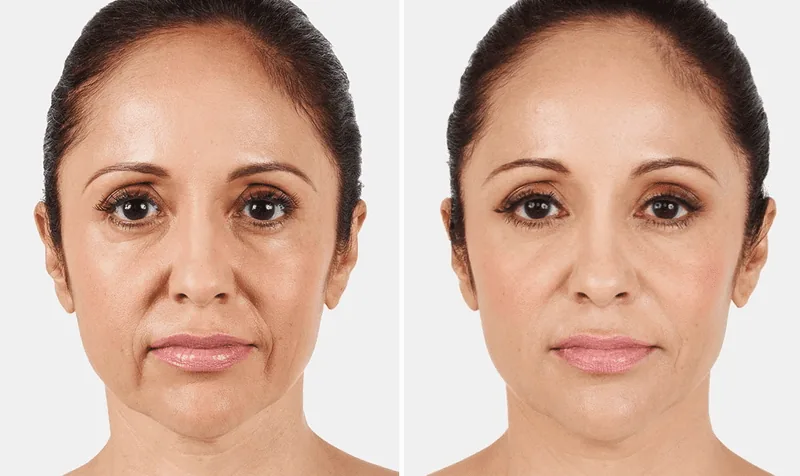 Juvederm Lip Fillers in San Antonio: What to Know