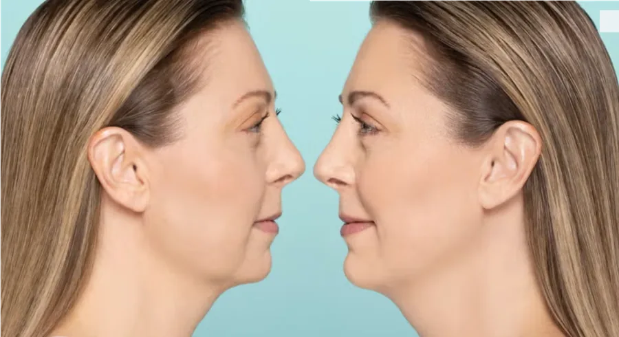 Kybella vs. Dermal Fillers for Jawline Contouring