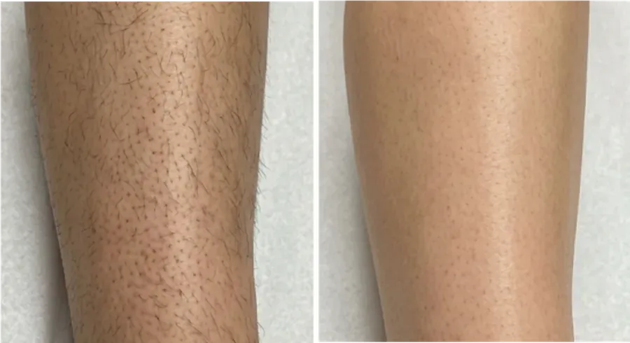 Is Laser Hair Removal Worth It in San Antonio?