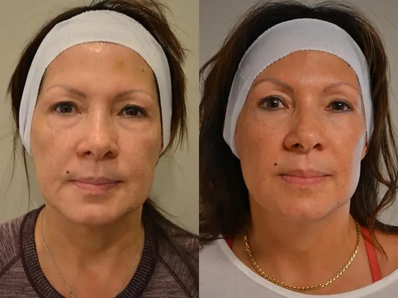 Ultherapy San Antonio: Your Complete Guide