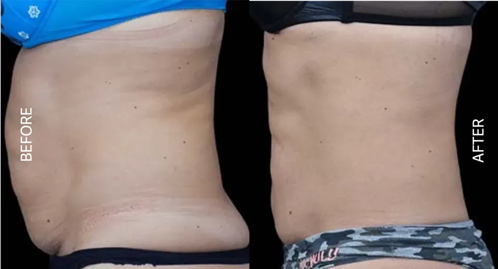 EmSculpt before and after abdomen result, side view