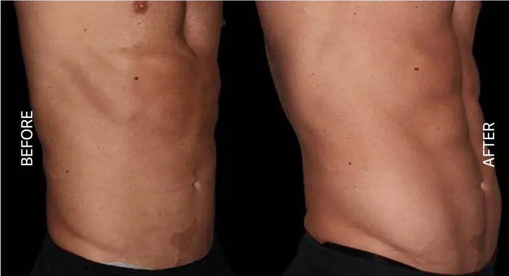EmSculpt before and after abdomen result, front view