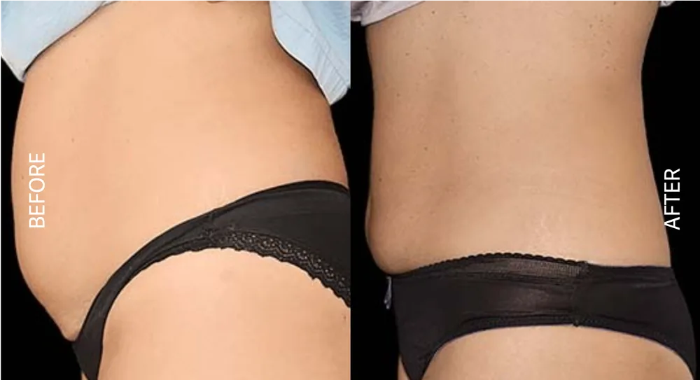 EmSculpt before and after abdomen result, back view