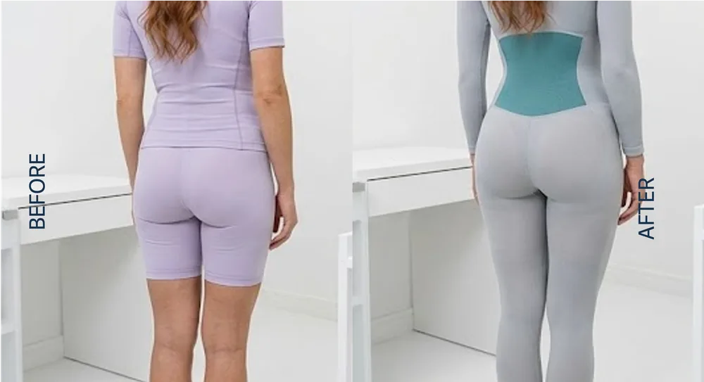 Sculptra Butt Lift before and after result, patient 2
