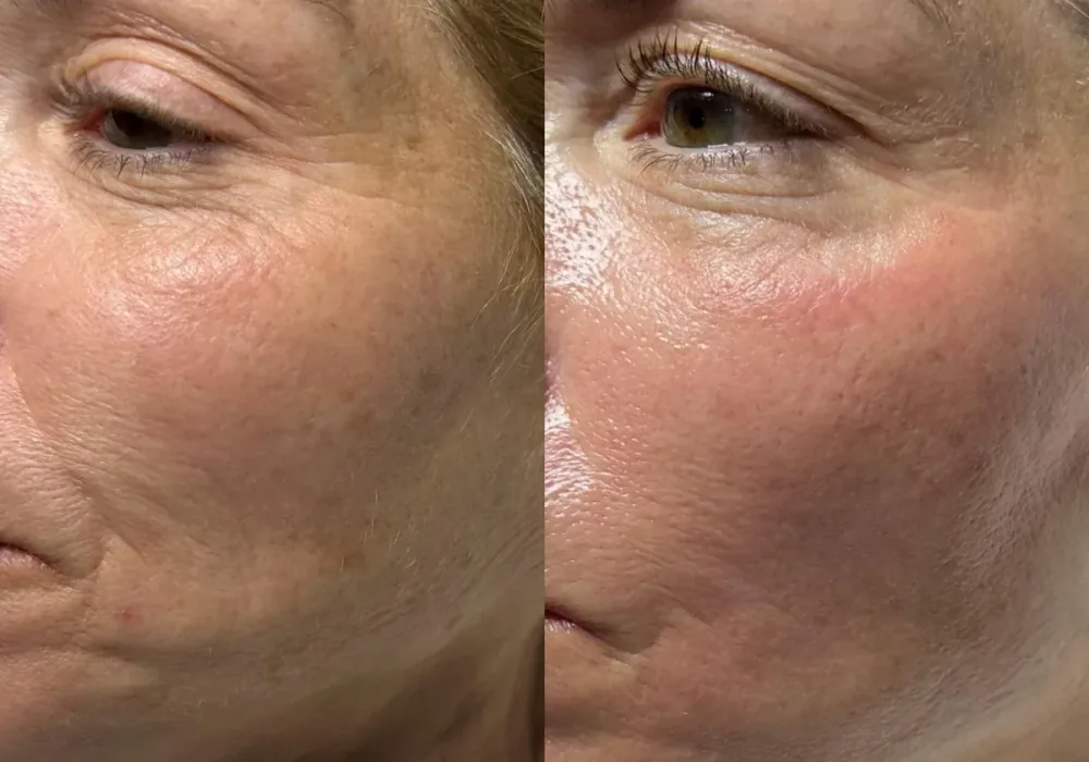 HydraFacial patient result