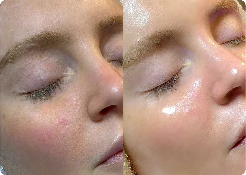 HydraFacial patient result