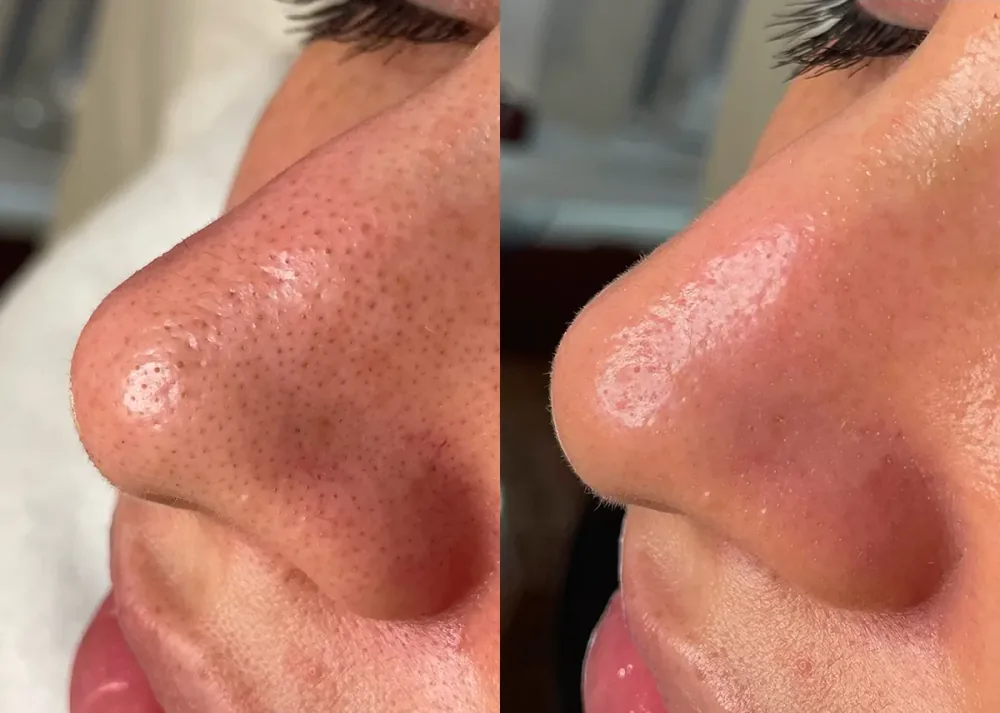 HydraFacial patient result