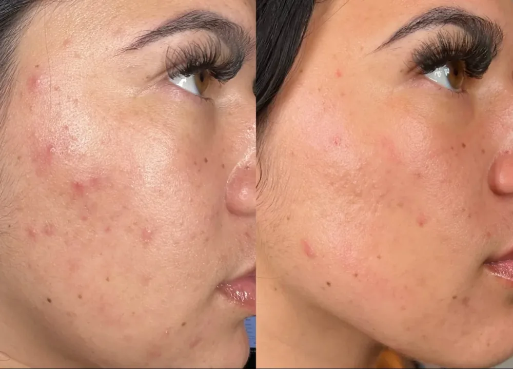 HydraFacial patient result