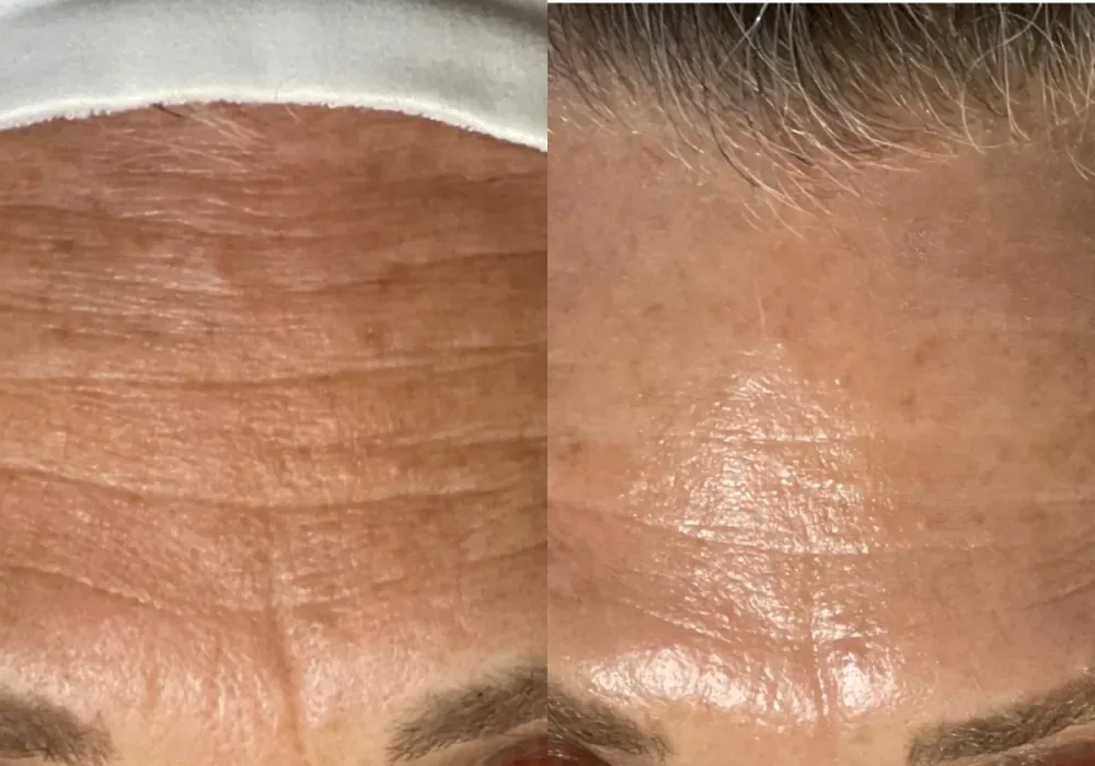 HydraFacial patient result