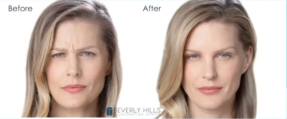 Botox patient before and after result