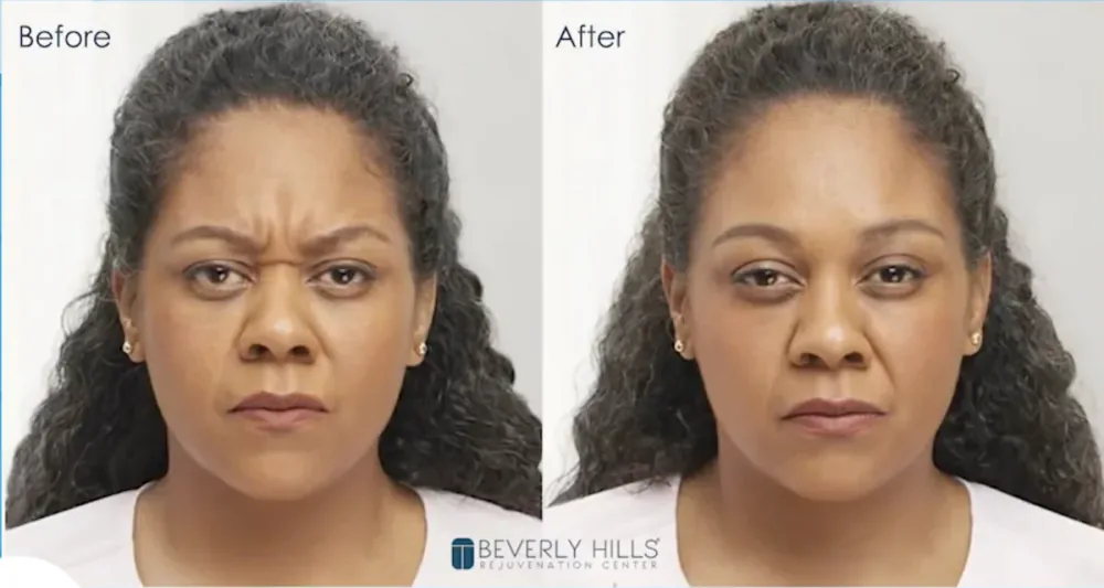 Botox patient before and after result