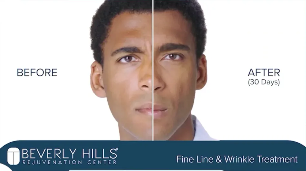 Botox patient before and after result, fine line and wrinkle treatment