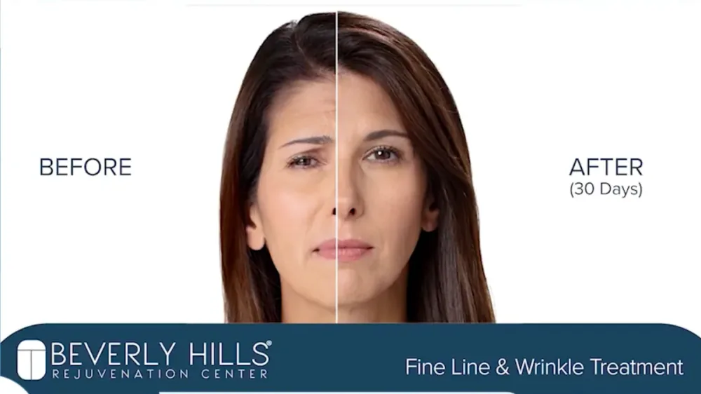 Botox patient before and after result, fine line and wrinkle treatment