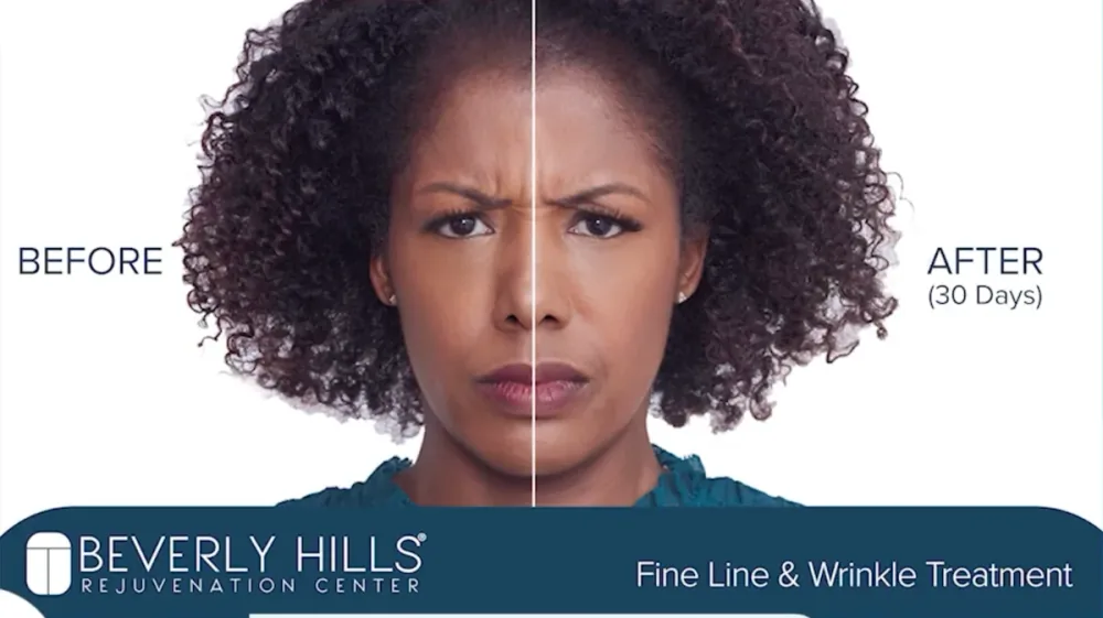 Botox patient before and after result, fine line and wrinkle treatment