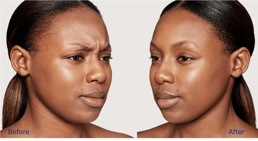 Dysport patient result
