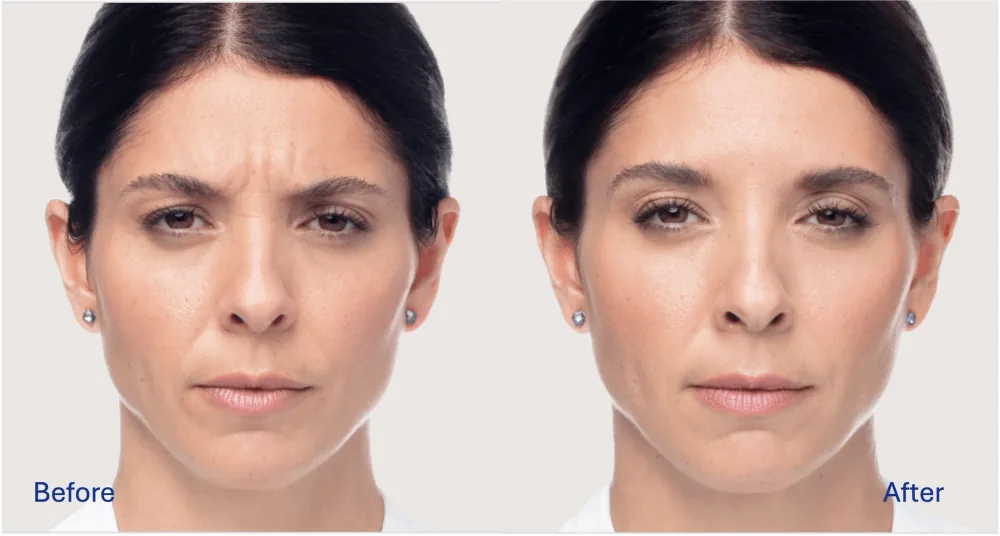 Dysport patient result