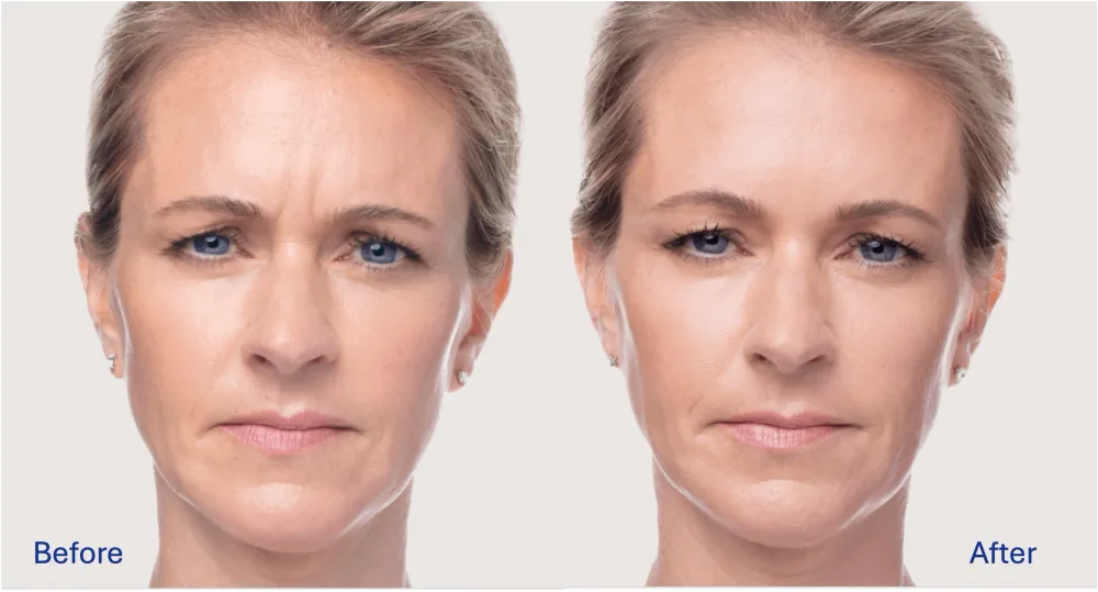 Dysport patient result