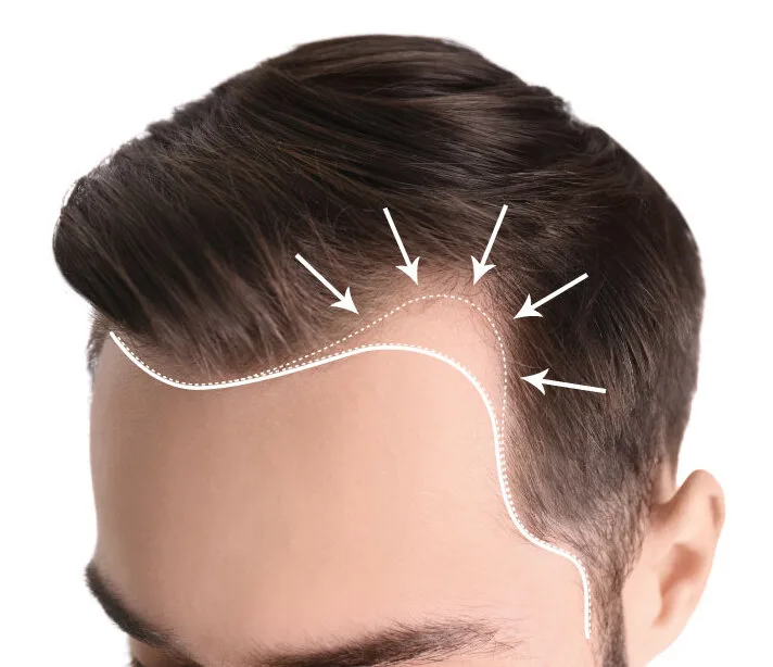 Hair Restoration
