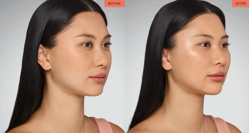Juvederm patient result