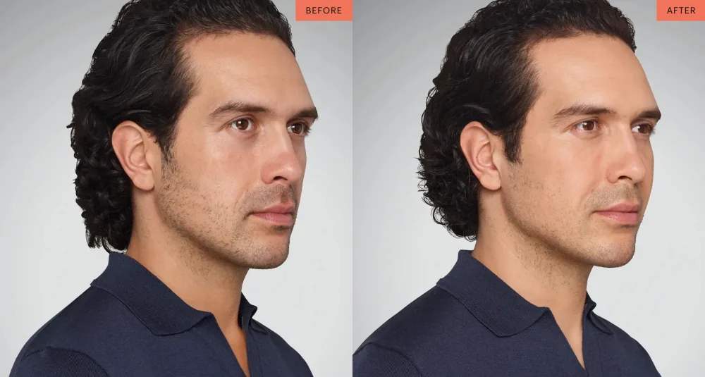Juvederm patient result
