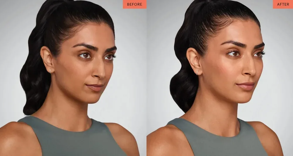 Juvederm patient result