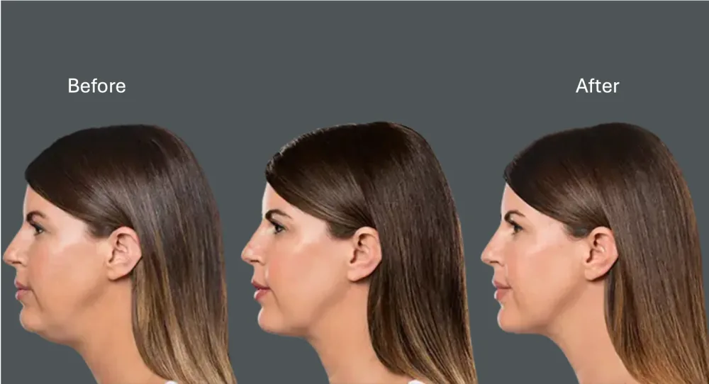 Kybella patient before and after chin contouring