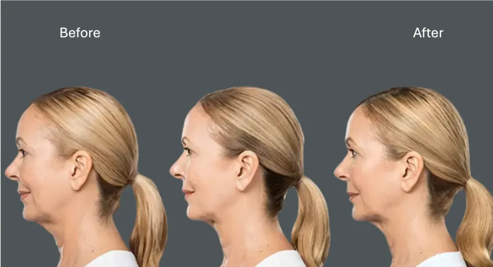 Kybella jawline definition result