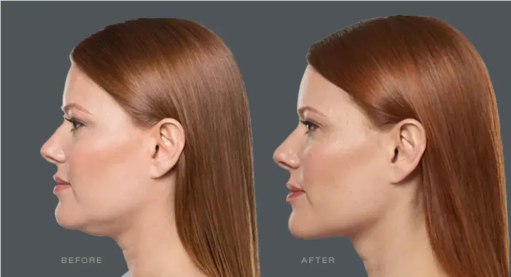 Kybella double chin treatment result