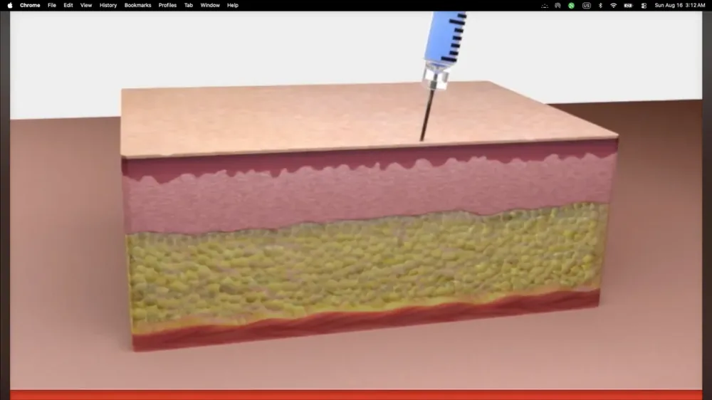 See Kybella in Action