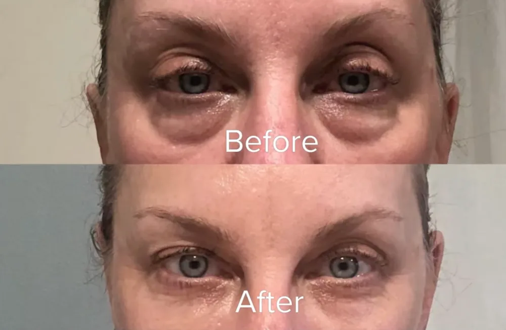 PRP/PRF under-eye patient result