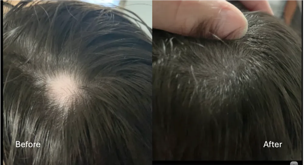 PRP/PRF scalp patient result