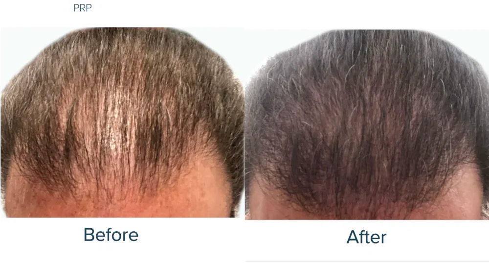 PRP/PRF hairline patient result