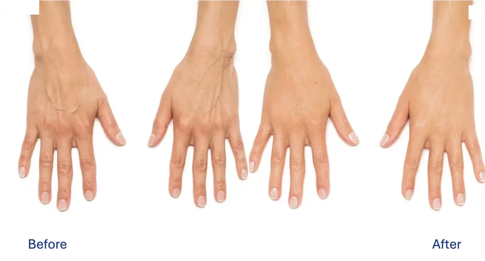 Radiesse patient result