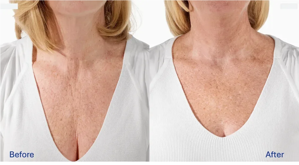 Radiesse patient result