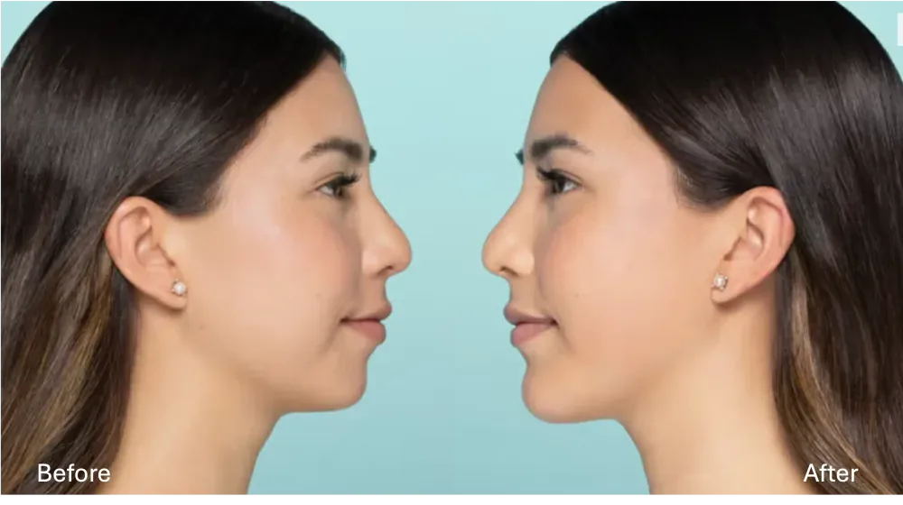 Restylane patient result
