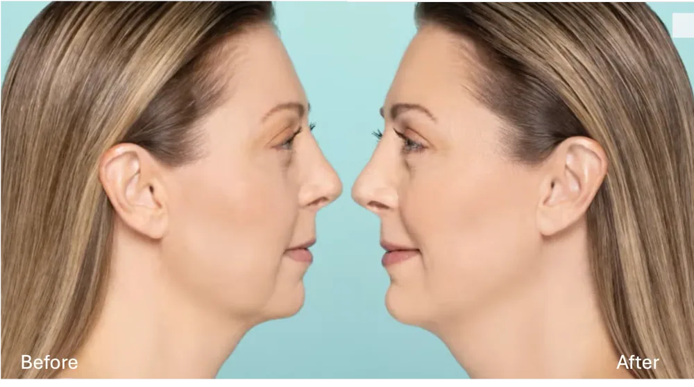 Restylane patient result