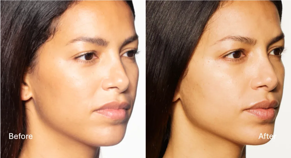 Sculptra patient result