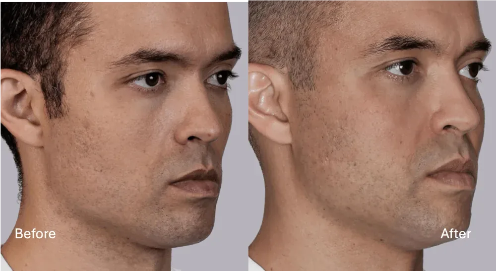 Sculptra patient result