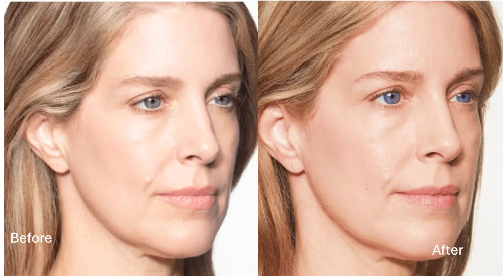 Sculptra patient result