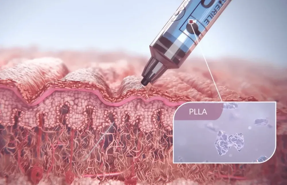 See Sculptra in Action