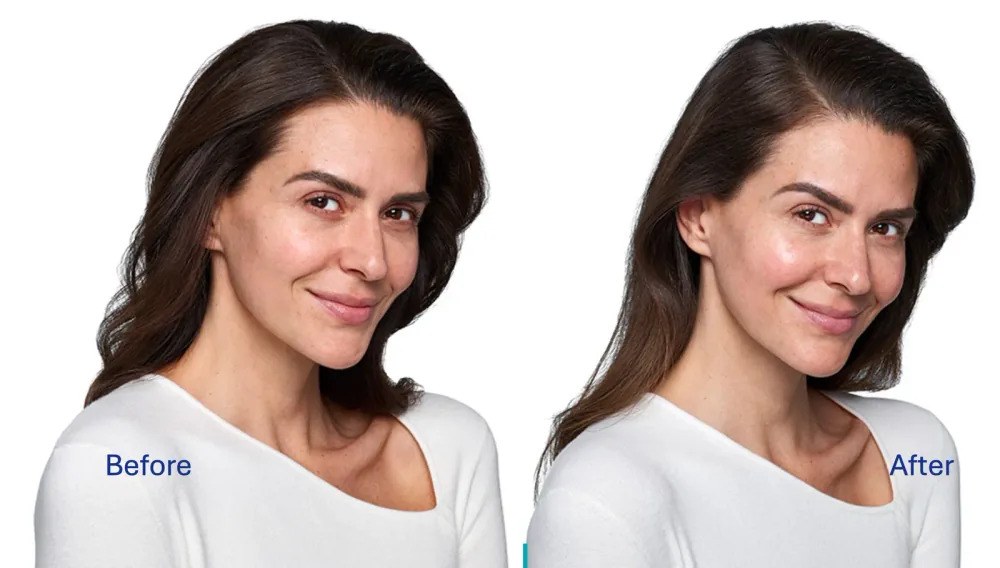 Skinvive before and after result