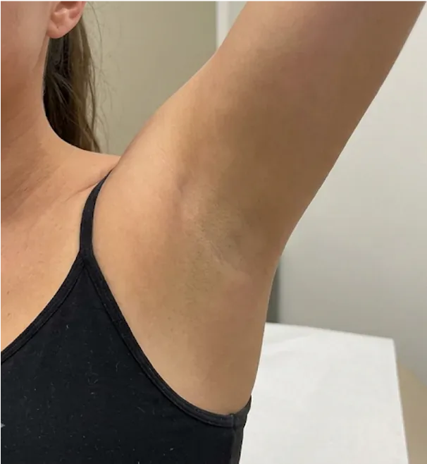 Standard Laser Hair Removal