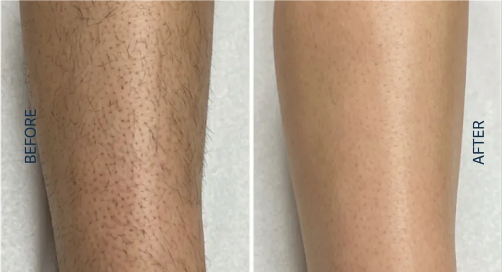 Alma Soprano Ice patient result, lower leg