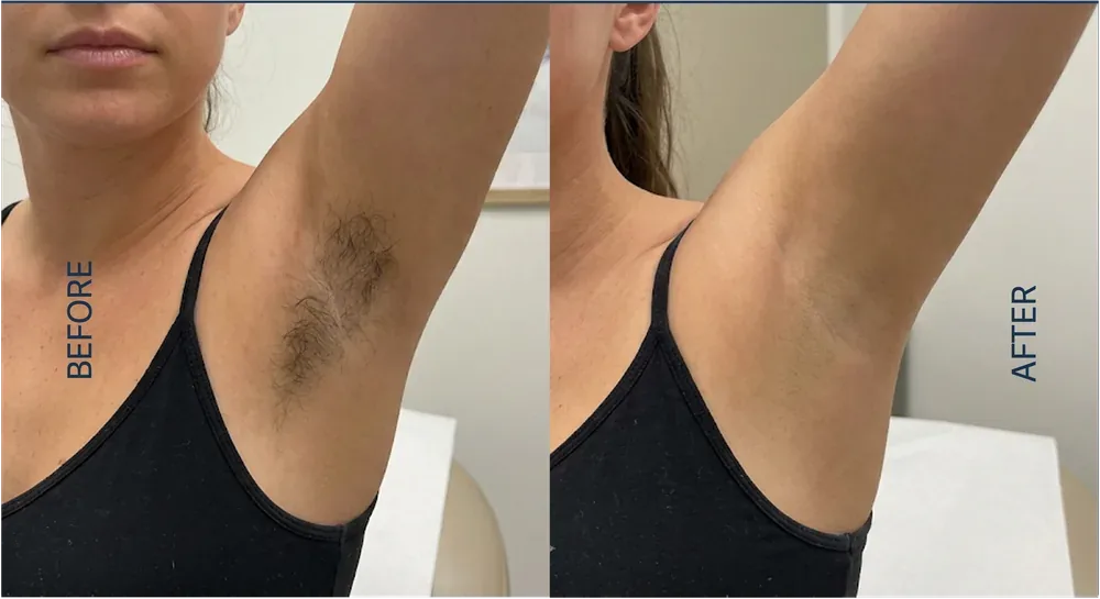Alma Soprano Ice patient result, underarm