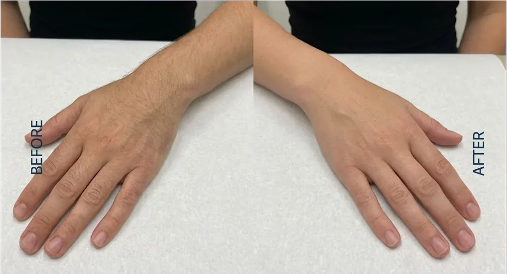 Alma Soprano Ice patient result, forearm and hand