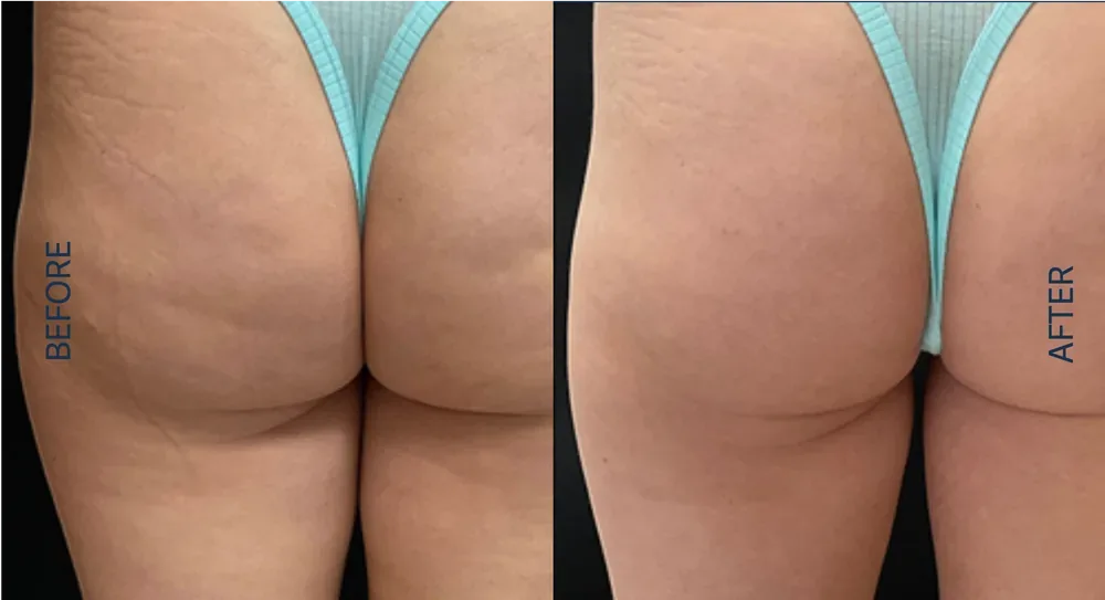 Morpheus8 patient result, buttocks skin tightening