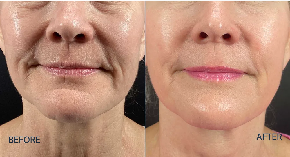 Morpheus8 patient result, lower face and chin tightening