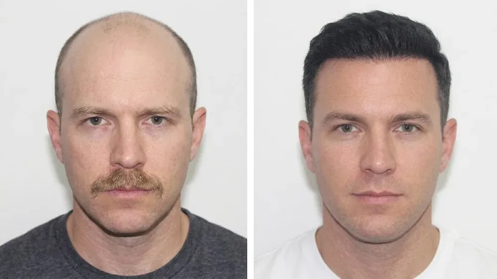 PRP hair restoration before and after result, patient 1